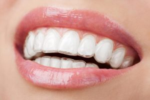 Invisalign Kimlere Yapılır?