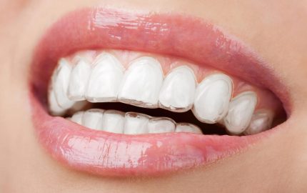 Invisalign Kimlere Yapılır?