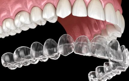 Invisalign Tedavi Süreci Aşamaları