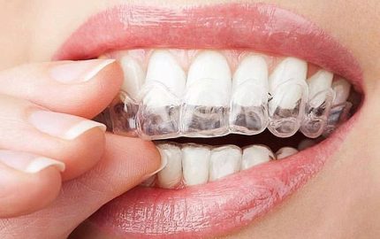 İnvisalign Tedavisi Nasıl Yapılır?