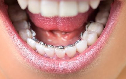 İnvisalign (telsiz ortodonti/diş düzeltme)